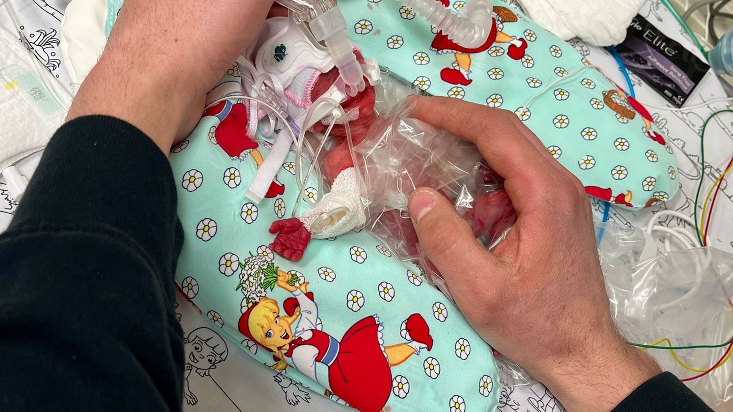 Passau: „Ein kleines Wunder“: Baby überlebt trotz 265 Gramm Geburtsgewicht