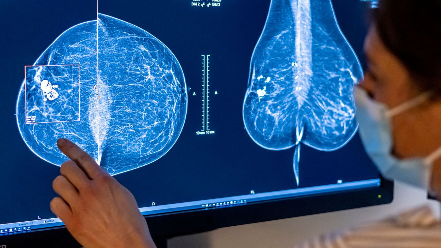 Brustkrebs-Früherkennung: Tausende Frauen ab 70 zu Mammografie-Programm eingeladen