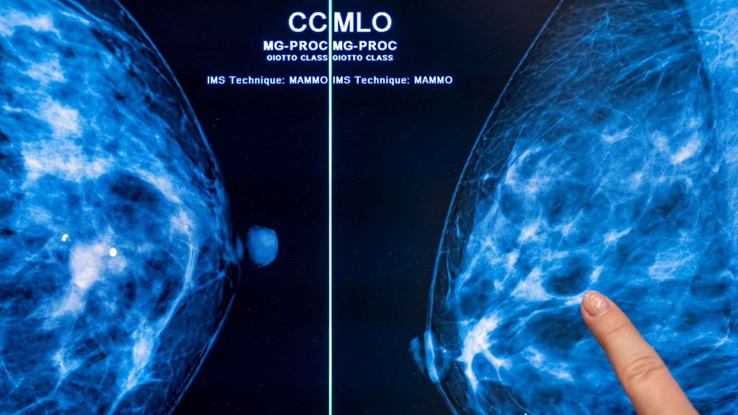 Programm zur Früherkennung: Mammografie-Screening senkt Brustkrebs-Sterblichkeit