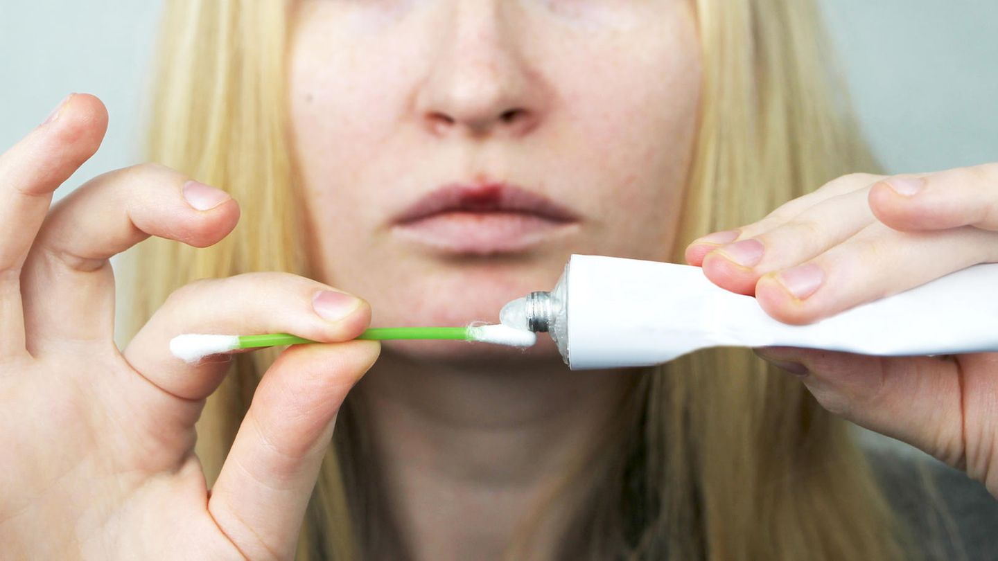 Lippenbläschen: Herpes-Creme im Vergleich: Diese Produkte lindern typische Symptome