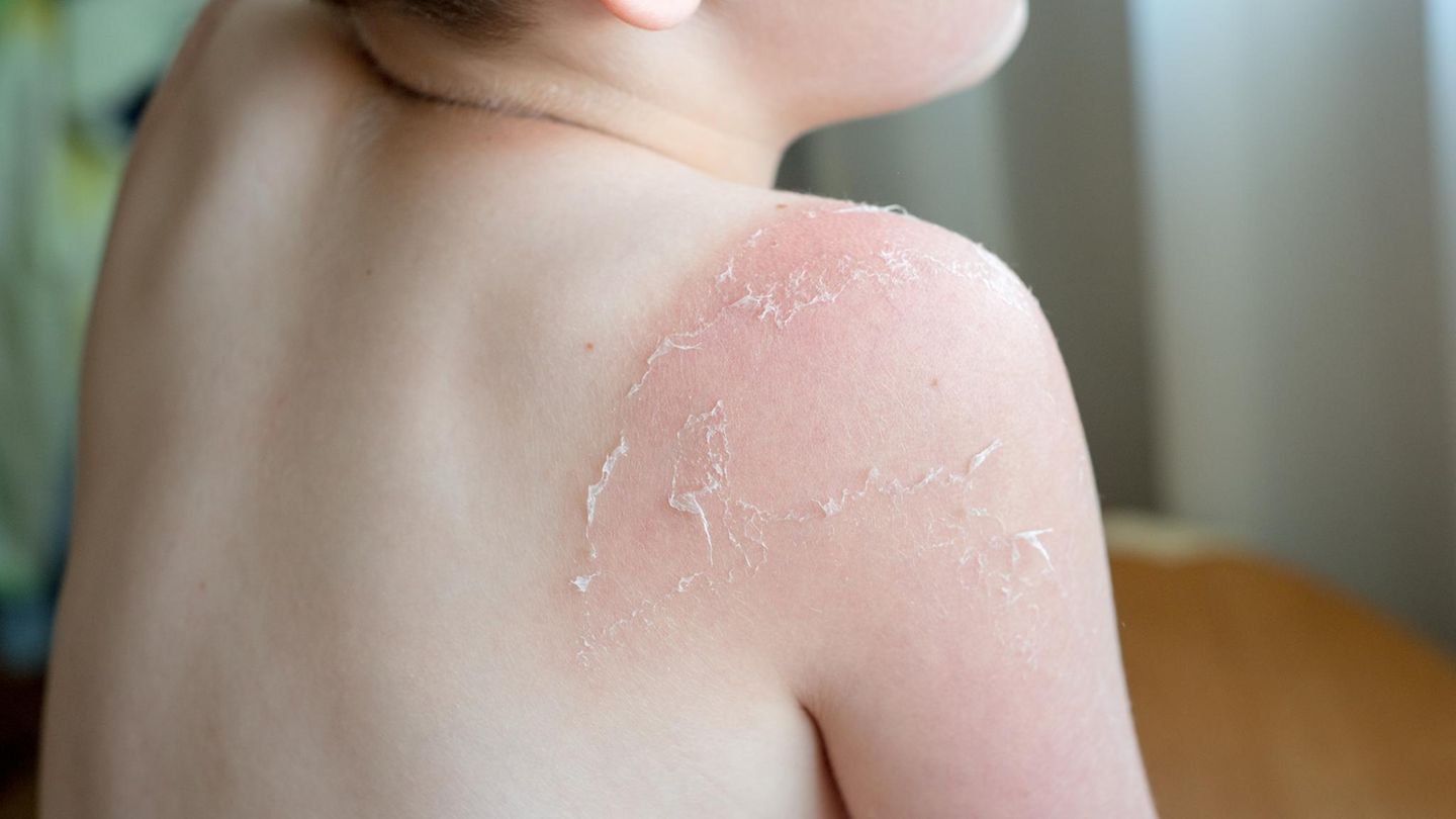 Auf Sylt: Sonnenbrand auf Klassenfahrt: Schülerin im Krankenhaus, Anzeige gegen Lehrer