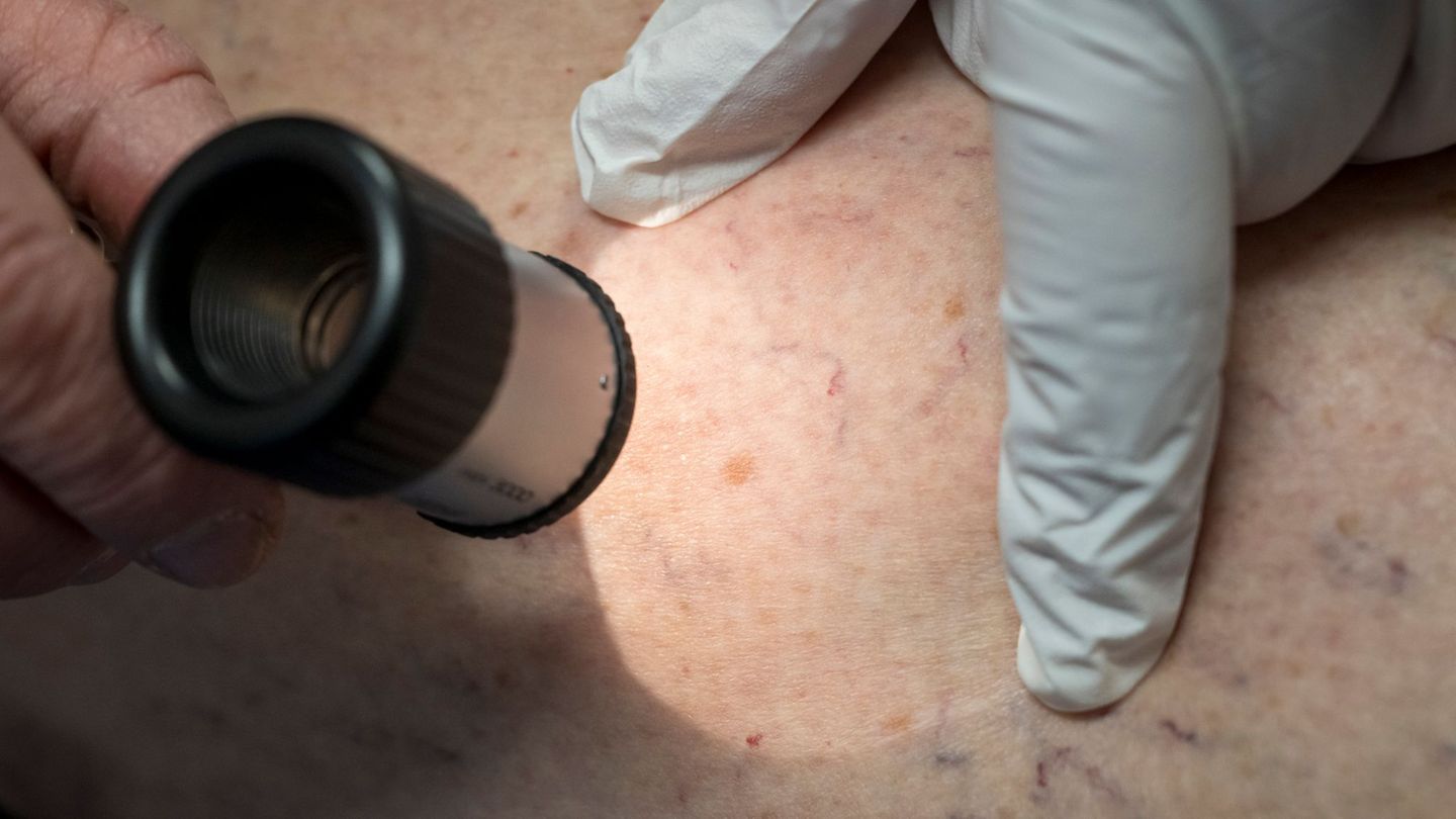 Gesundheit: Krankenkasse: Deutlich mehr Hautkrebsfälle in Niedersachsen